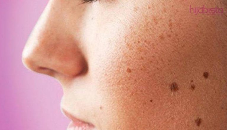 Kulit Tanpa Cela! 9 Rawatan ‘Dark Spot’ Yang Berkesan, Menurut Ahli Dermatologi