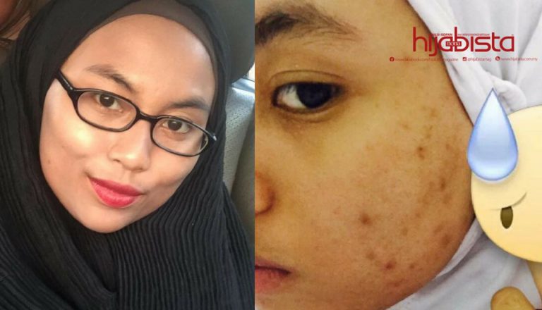 Dunia Jadi Gelap Bila Jerawat Keluar Di Muka. 7 Produk Ini Yang Telah Selamatkan Wajah Dari ‘Breakout’.