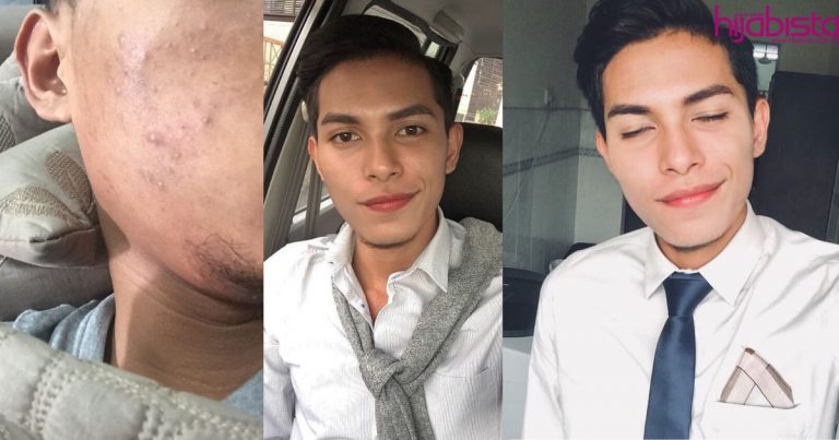 Cecah Ribuan Retweet, Jejaka Ini Kongsi Cara Pulih Dari Breakout Dengan Kos Murah