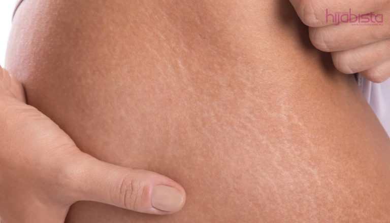 Stretch Marks Bukan Timbul Hanya Pada Wanita Bersalin Malah Remaja Juga Berisiko. Bagaimana Mengatasinya