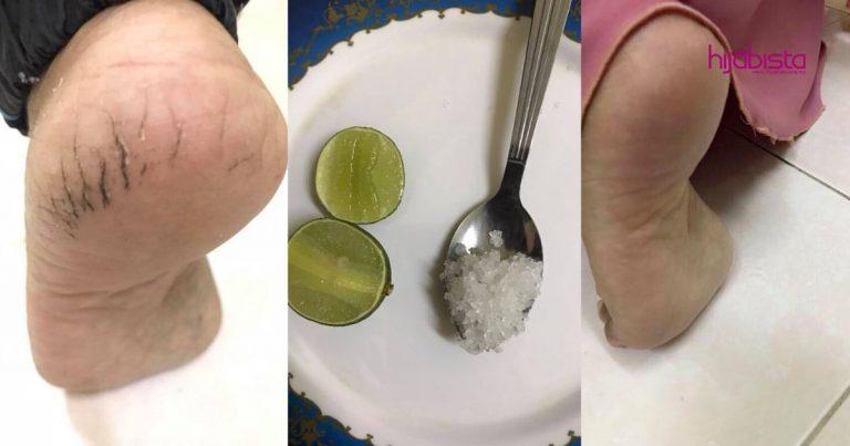 Cerahkan Tumit Kaki Yang Hitam Merekah, Gadis Ini Selesaikan Dengan 2 Bahan Sahaja!