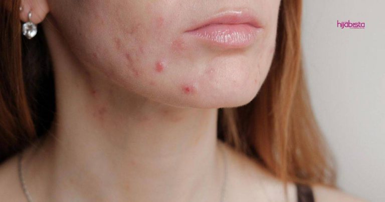 Masalah Breakout Bukan Remaja Sahaja Yang Hadapi Tapi Golongan Dewasa, Doktor Ini Kongsi Sebabnya