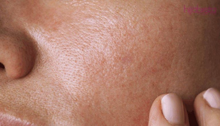 Masalah Kulit Kombinasi Yang Susah Diuruskan, Inilah Cara Menurut Pakar Dan Produk Cadangan Terbaik