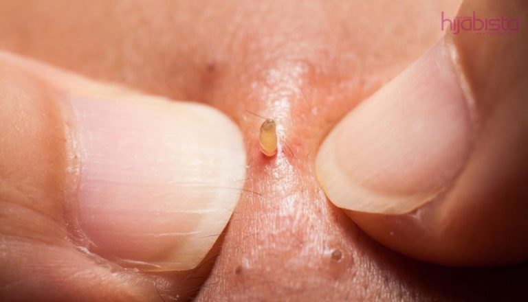 Perbetulkan Cara Anda Menghilangkan Blackhead di Wajah.15 Tip Dari Pakar Hasilnya Memang Berkesan!