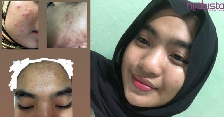 Lepas Buat Research, Gadis Kongsi Rutin & Produk Pulihkan Kulit Wajahnya Dari Breakout