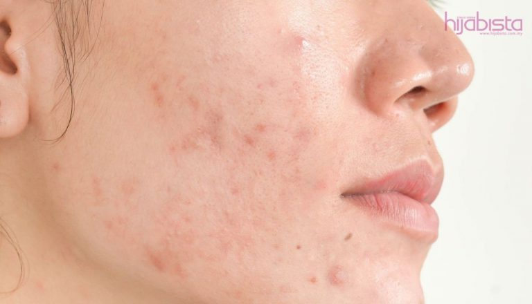 Cara Menghentikan ‘ACNE’ Dan 7 Petua Elak Kulit Yang Rengsa Kemerahan Terus Merebak