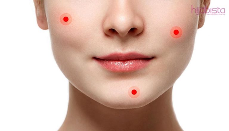 Soalan Lazim Tentang Breakout Dan Senarai Produk Terbaik Bantu Hilangkan Rawan Kemerahan