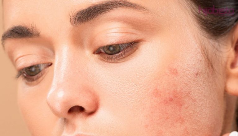 7 Kesalahan Penjagaan Kulit Yang Boleh Mengundang Jerawat Tumbuh