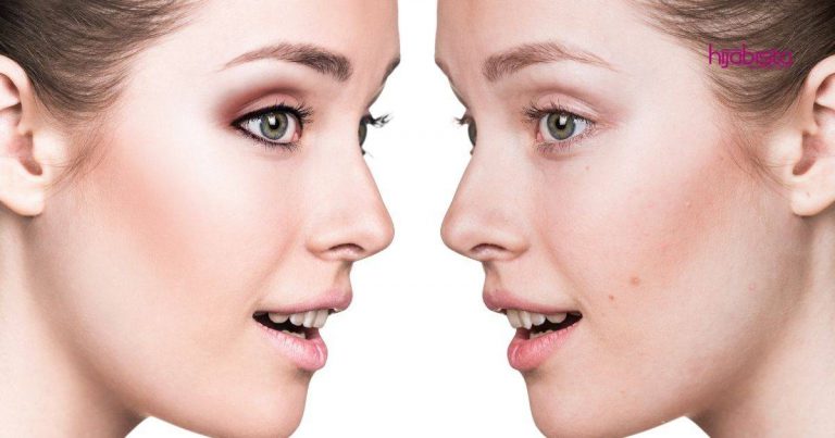 Maskne Jerawat Yang Tumbuh Akibat Guna Pelitup Muka Yang Kerap, Lelaki Ini Kongsi Cara Atasi