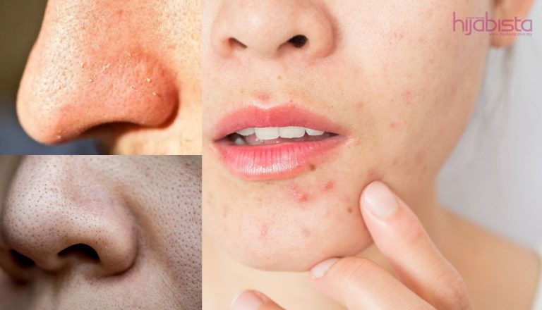 Semua Yang Anda Perlu Tahu Mengenai ‘Breakout’ Dan Cara Menyingkirkannya