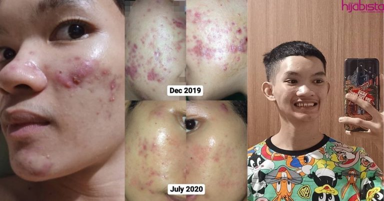 Pernah Disuruh Kikis Muka Guna Kertas Pasir, Lelaki Buktikan Boleh Dapat Kulit Sihat Lepas Breakout