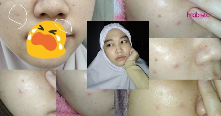 Gadis Ini Kongsi Cara Rawat Maskne, Memang Berkesan! Kulit Wajah Jadi Licin Semula