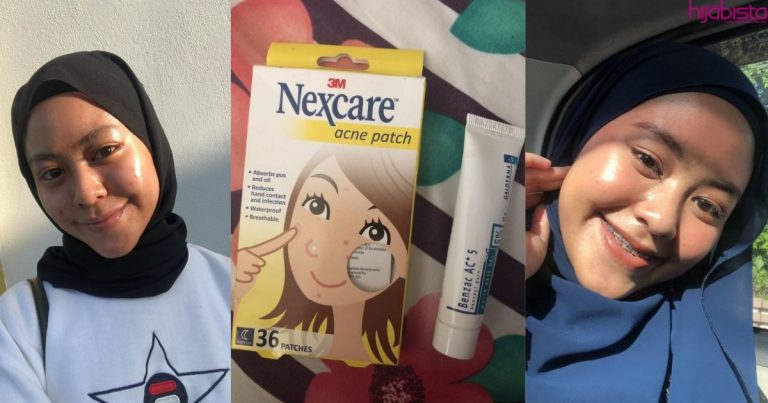 Muka Breakout Sebab Stress Exam, Gadis Ini Temui Cara Pulihkannya Dalam Masa Singkat & Selamat