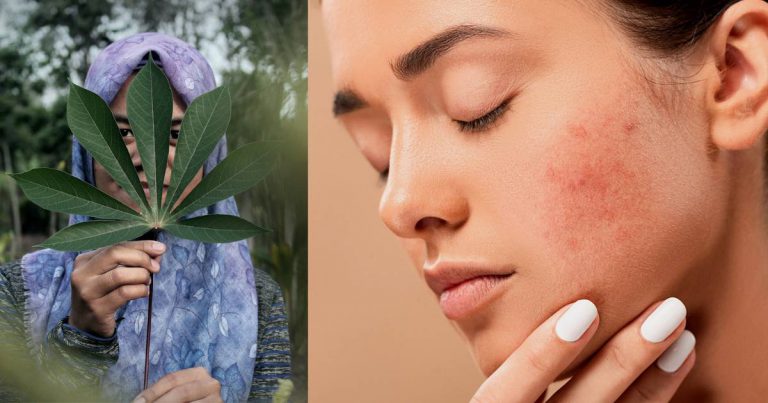 Tampil Lebih Menawan. Ini Cara Ringkas Menghilangkan Parut Luka & Jerawat.