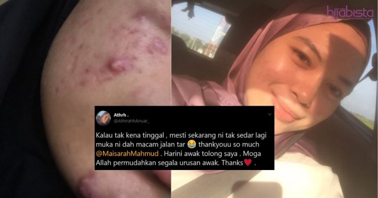 Asbab Ditinggalkan, Wanita Ini Berjaya Pulihkan Masalah Jerawat. Kini Makin Flawless!