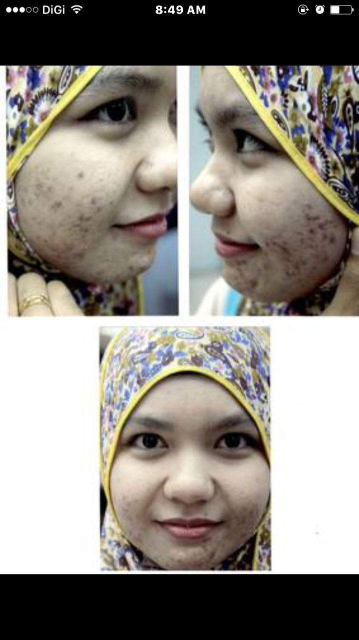 Wajah Breakout Teruk, Wanita Ini Kongsi Rawat Kulit Sampai Kembali Flawless 16 Wajah Breakout Teruk, Wanita Ini Kongsi Rawat Kulit Sampai Kembali Flawless