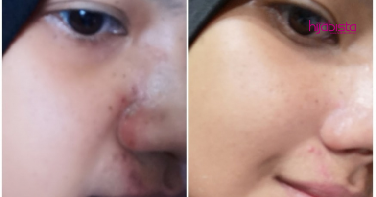 Kayap Menjalar Panjang Di Muka, Wanita Ini Kongsi Cara Rawat