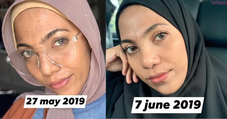 Produk Jerawat Biasa Takkan Berkesan, Wanita Ini Dedah Cara Yang Betul Bagi Rawat Fungal Acne