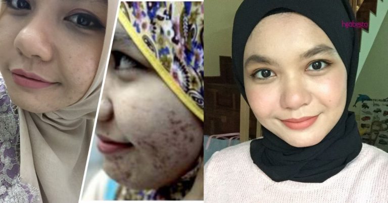 Wajah Breakout Teruk, Wanita Ini Kongsi Rawat Kulit Sampai Kembali Flawless