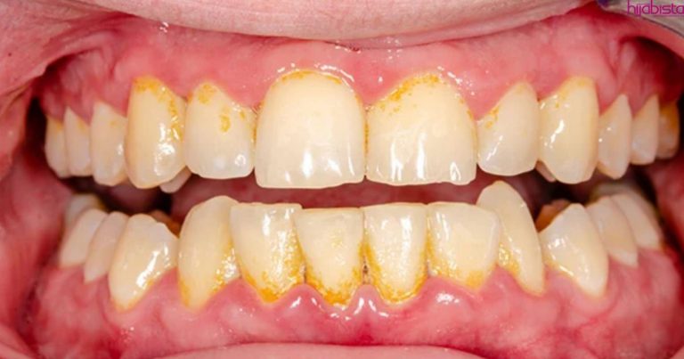 Setiap Hari Berus Gigi Namun Karang Gigi Tetap Ada? Ini Sebabnya Yang Anda Tak Tahu