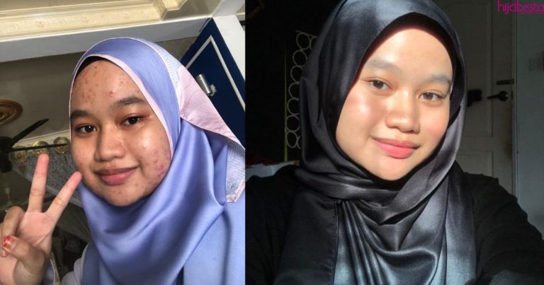 Kini Miliki Kulit Flawless Lepas Breakout Kerana Alahan Seafood, Gadis Ini Kongsi Rahsianya