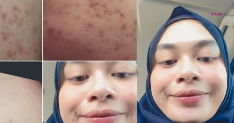 Gadis Ini Kongsi Cara Dia Rawat Masalah Breakout Yang Dihadapinya, Penting Guna Produk Yang Tepat