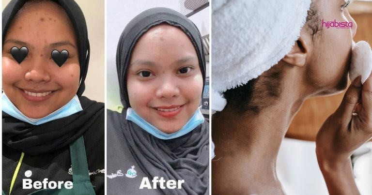 Gadis Ini Kongsi Bagaimana Dia Rawat Masalah Breakout Yang Dialami, Salah Satunya Kurangkan Makanan & Minuman Manis