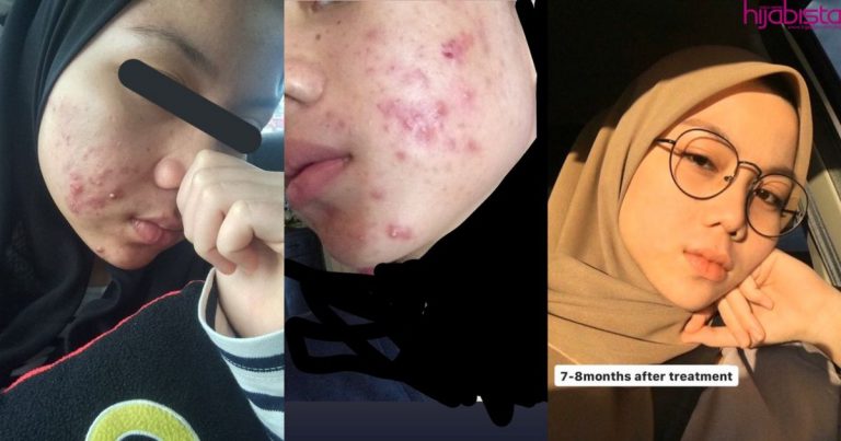 Kulit Kini Licin Macam Kaca, Gadis Ini Kongsi Cara Pulihkan Breakout Dengan Kos RM5 Je!