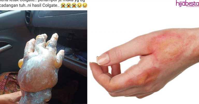 Jangan Ikut Petua Mengarut! Doktor Ini Kongsi Cara Sebetulnya Bagi Rawat Kelecuran