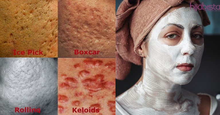 Rupa-Rupanya Tak Semua Parut Sama, Ini Jenis Parut Berlubang Yang Perlu Anda Tahu