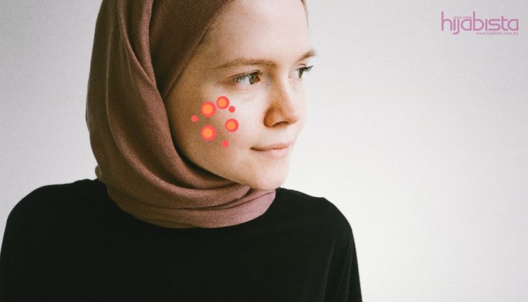 Cara Menghilangkan Jerawat Buta Tanpa Menggunakan Produk Penjagaan Kulit