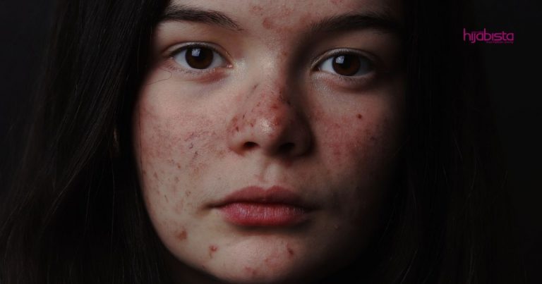 Tangan ‘Suka’ Picit Jerawat? Doktor Kulit Ini Kongsi Tip Cara Betul Kempiskan Jerawat Bernanah