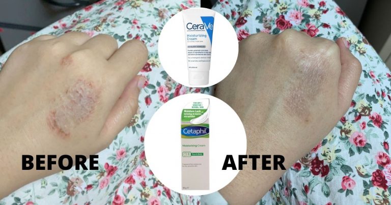Sengsara Ekzema Tak Boleh Bawa Bincang! Gadis Ini Kongsi Produk Yang Bantu Rawat Kulitnya
