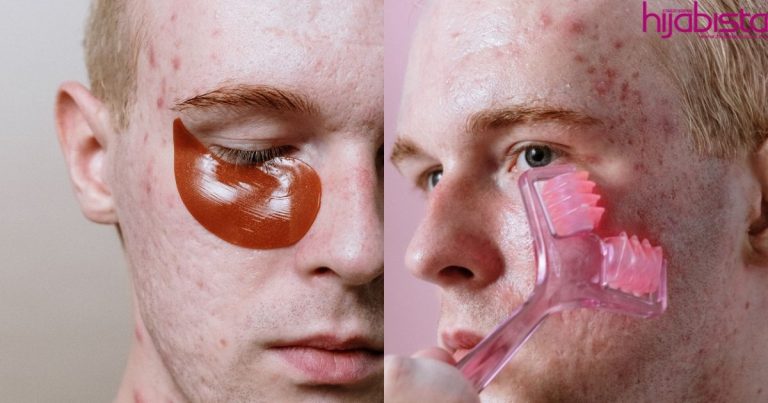 Jerawat Batu Menyerang, Doktor Ini Sarankan 5 Cara Mudah Bagi Menghilangkannya