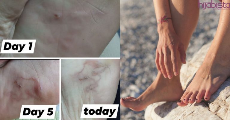 Tak Sangka Kaki Dimasuk Cacing, Wanita Ini Alami Kegatalan Yang Amat Hingga Kaki Bengkak