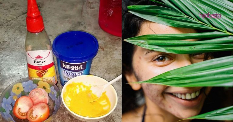 Kecutkan Jerawat Guna Bahan Dapur, Jimat & Tak Perlu Risau Kesan Sampingan