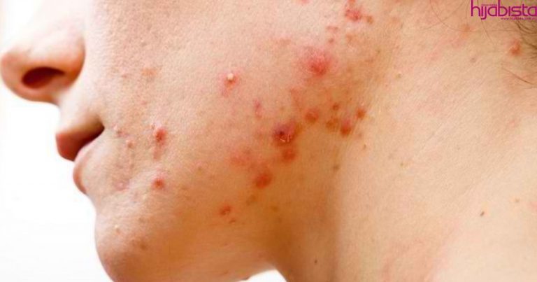 Rawat Masalah Jerawat Pasir, Pori Tersumbat & Tiny Bumps Dengan Langkah Mudah Ini!