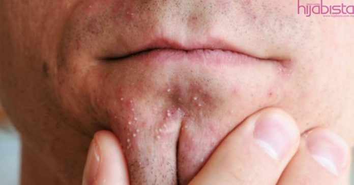 jerawat