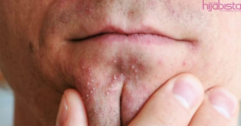 Ini Sebab Jerawat Kerap Muncul Di Dagu & Cara Mudah Lenyapkannya Mengikut Saranan Doktor