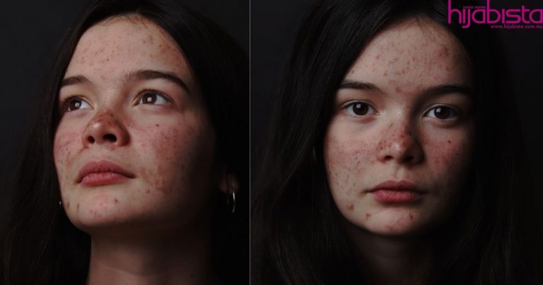 Takut Wajah ‘Breakout’ Lepas Berhenti Guna Produk Timbang Kilo, Ini Cara Mudah Untuk Atasinya