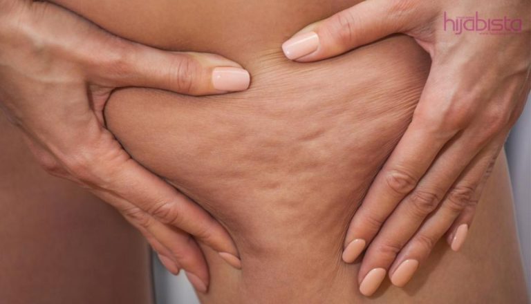 Kaum Wanita Lebih Ramai Hadapi Masalah Selulit, Amalkan Rawatan Mudah Ini!
