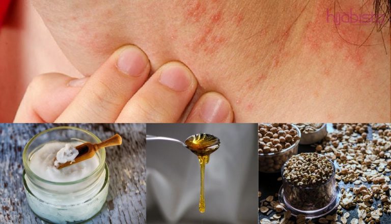 Rawatan Dirumah Yang Dapat Menenangkan Kulit Kering Dan Gatal, Hanya Dengan 10 Cara Ini.