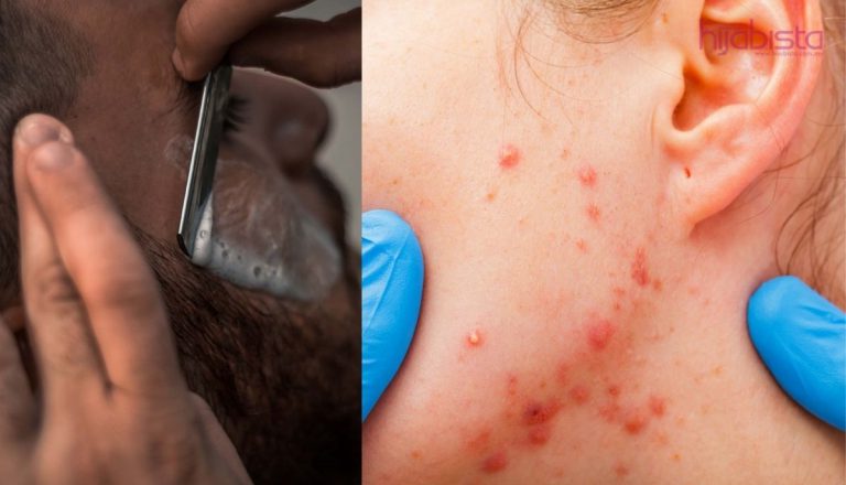 Jerawat Di ‘Jawline’ Mungkin Anda Mempunyai Tahap Hormon Lelaki Yang Lebih Tinggi. Ini Rawatan Tepat!