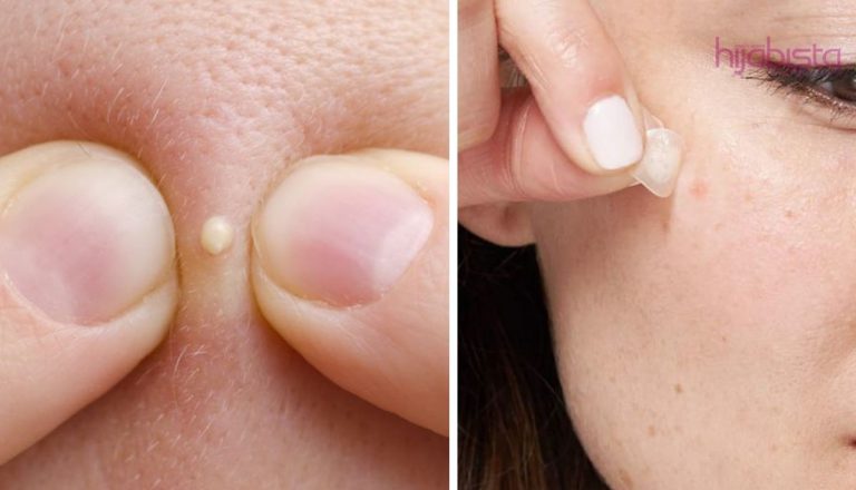 Inilah Cara Tepat Merawat Jerawat Semalaman. Sekelip Mata Hilang!