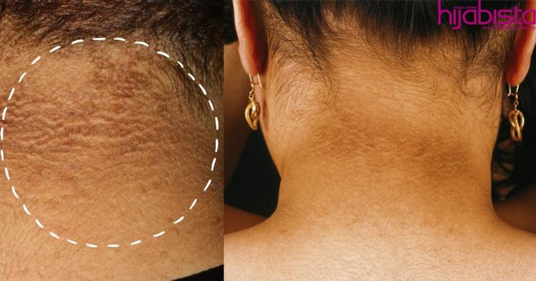 Disental Tak Hilang, Kulit Leher Berkerak Bukanlah Daki Tapi Petanda Awal Penyakit Serius