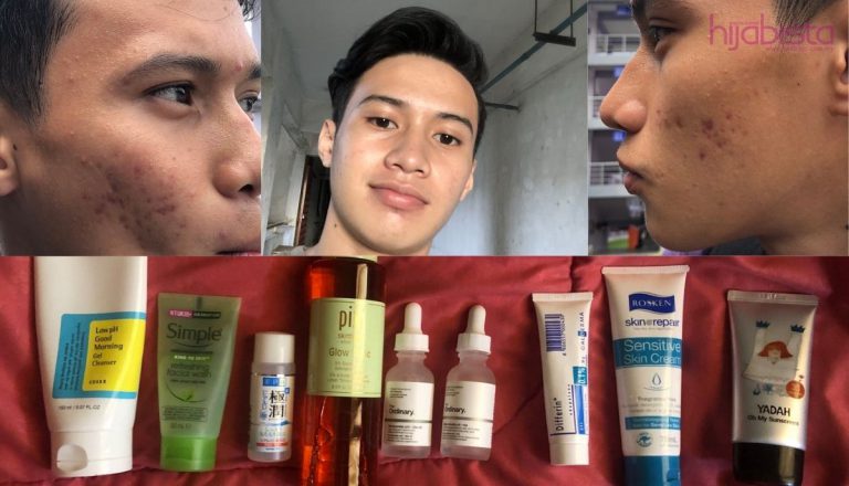 Segan Nak Selfie, Lelaki Ini Dedah Produk Untuk Pulih Wajah Breakout Dalam Masa 4 Bulan