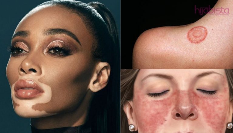 Gangguan Kulit Biasa Yang Boleh Mencacatkan Penampilan. Ada Yang Boleh Mengancam Nyawa.