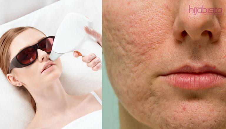 Parut Jerawat Hilangkan Keyakinan Diri. Licinkan Kulit Dengan Rawatan Laser Yang Efektif!