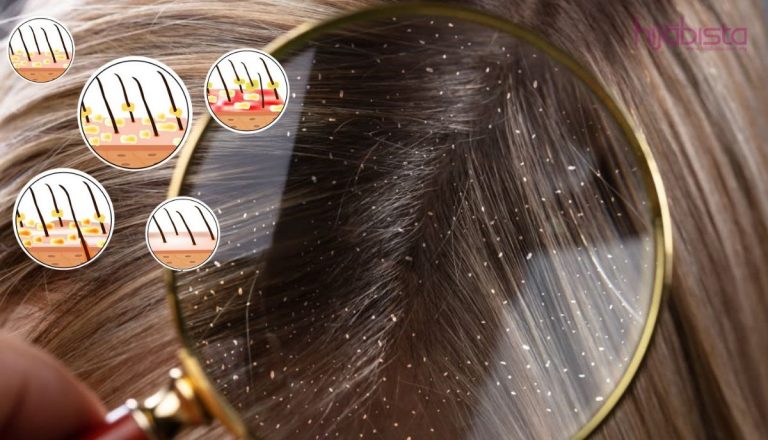 Nampak Serupa Tapi Berbeza, Kelemumur Dan Kulit Kepala Kering. Fahami Kaedah Rawatan Yang Betul