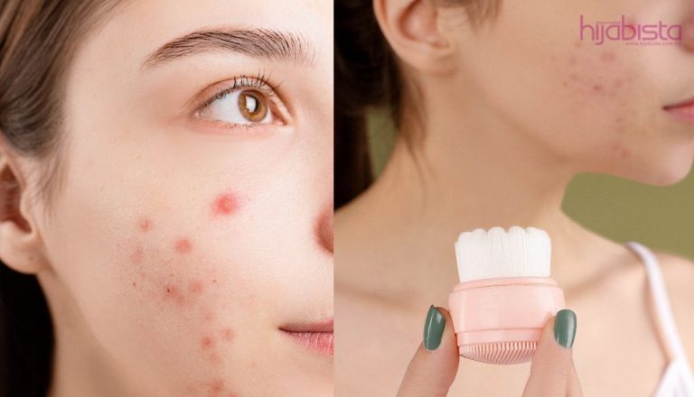 Wanita Ini Senaraikan Punca Utama Alami ‘Breakout’. Macam Tak Percaya Je!